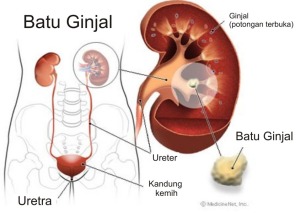 batu-ginjal