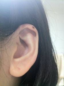 tahi lalat di kuping